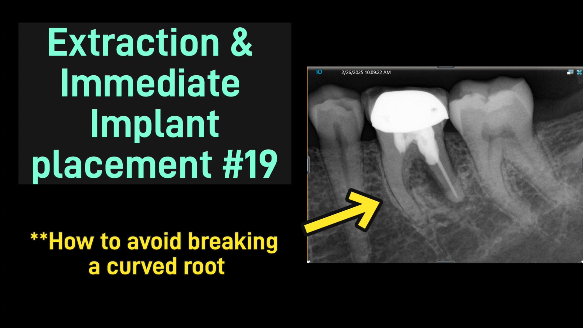 Extraction & Immediate Implant placement #19