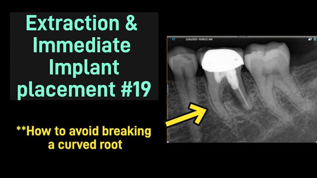 Extraction & Immediate Implant placem...