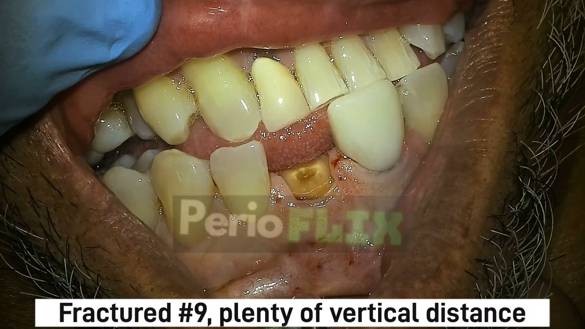 Extraction and implant #9 fractured crown