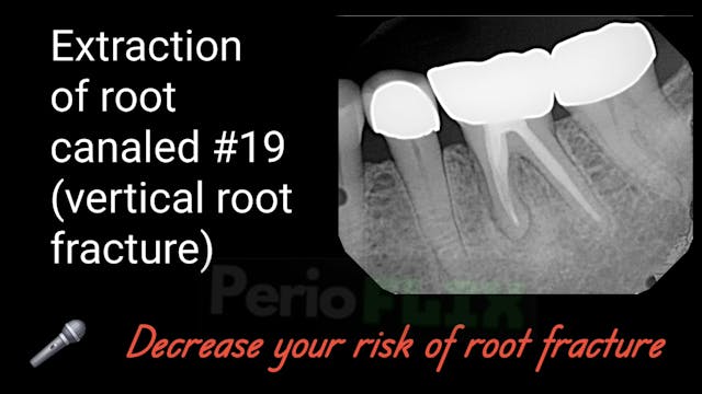 Extraction of root canaled #19