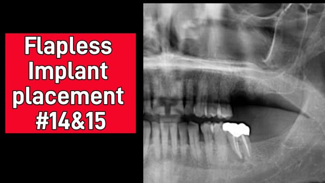 Flapless Implant placement #14 & 15
