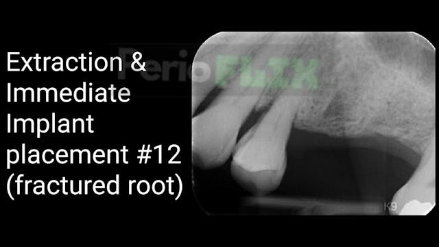 Extraction & Immediate Implant placem...
