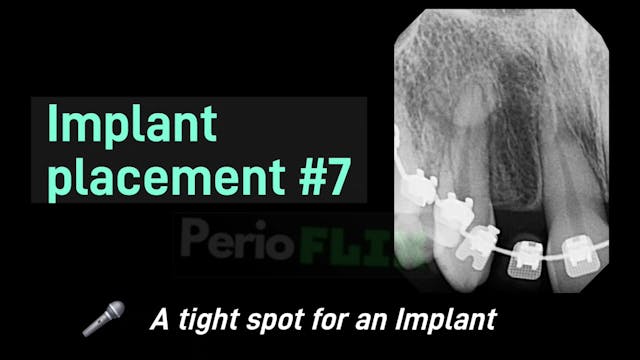 Simple Implant placement #7
