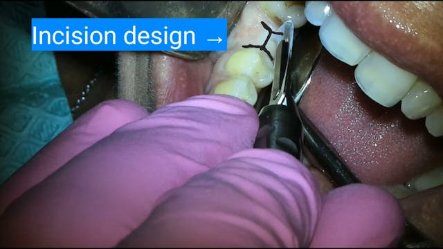Implant placement #30