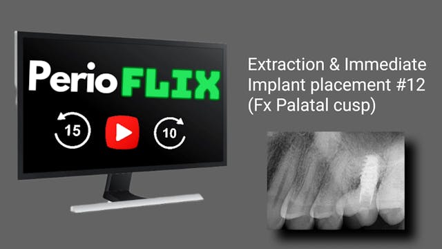 Extraction Immediate placement #12