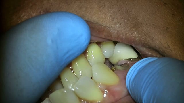 Extraction & Immediate Implant placem...