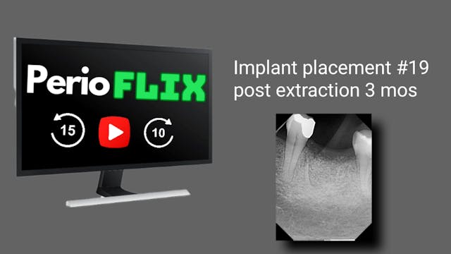 Implant placement #19 3 mos post extr...
