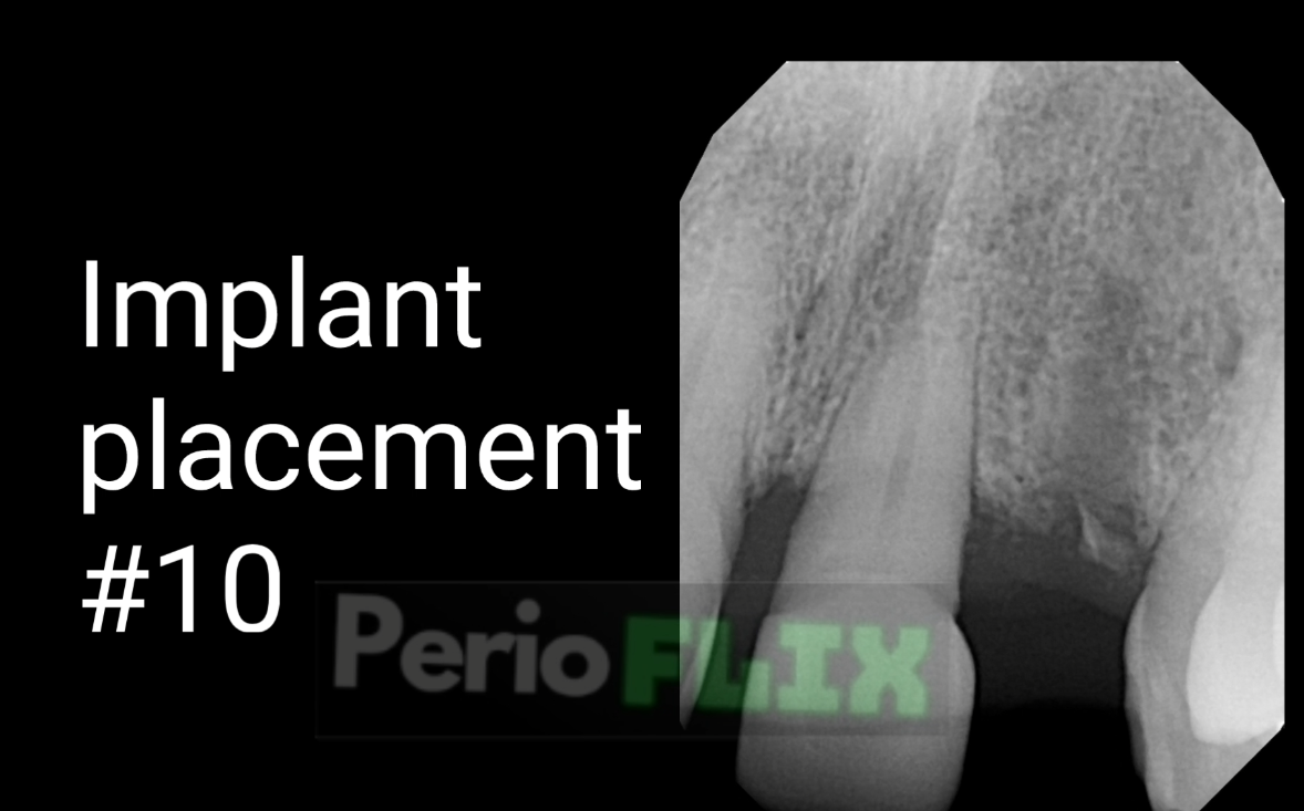 Simple Implant Placements in adequate ridges