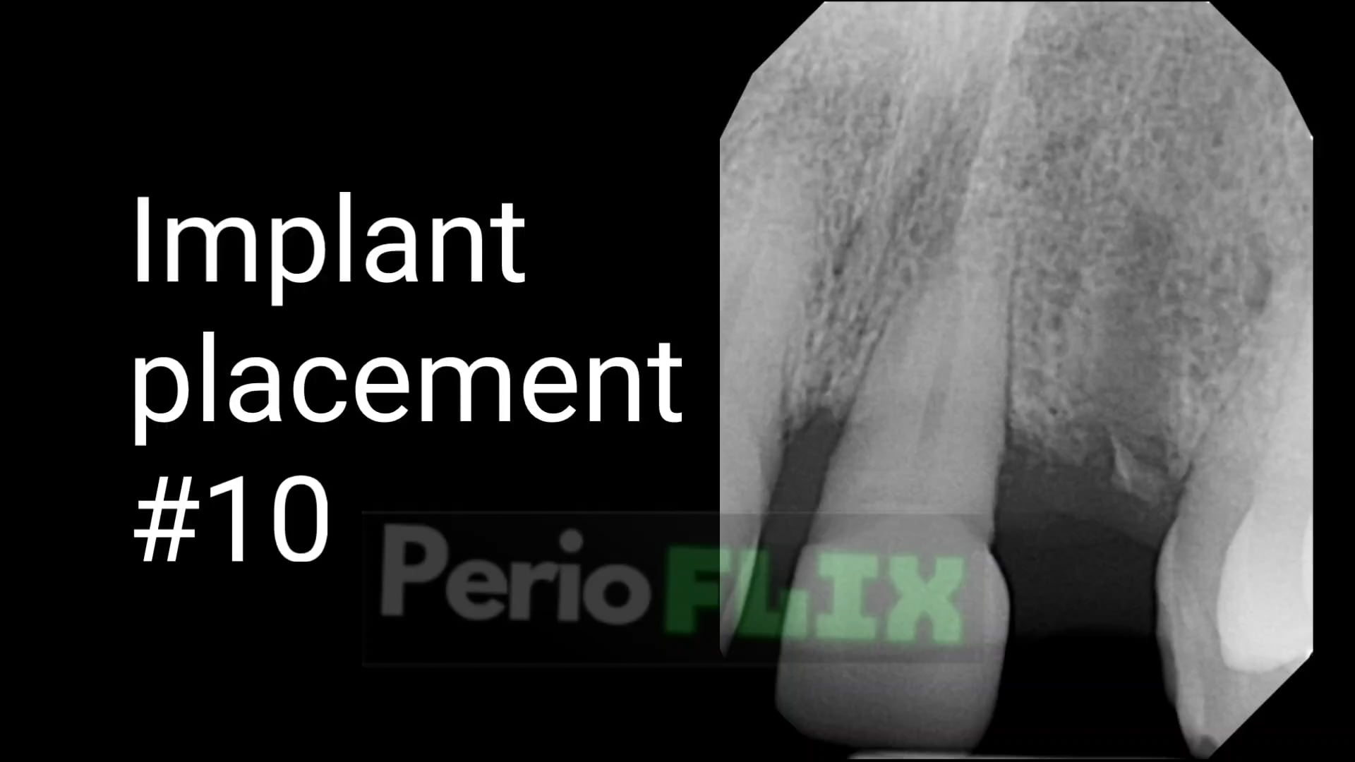 Implant placement 10