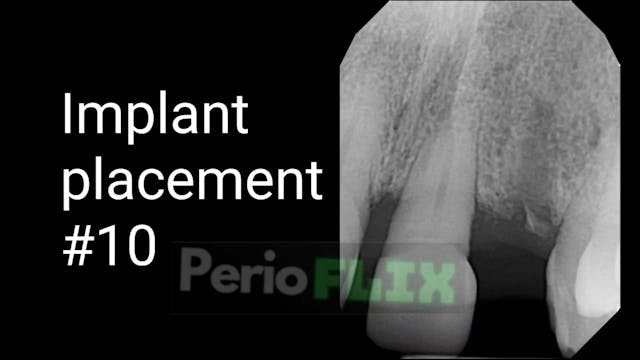 Implant placement 10