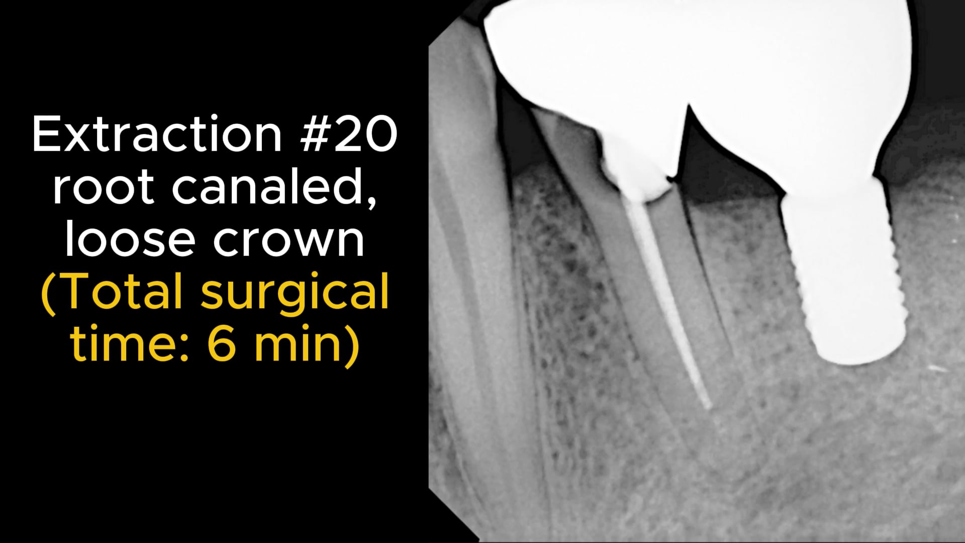Extraction of root canaled #20