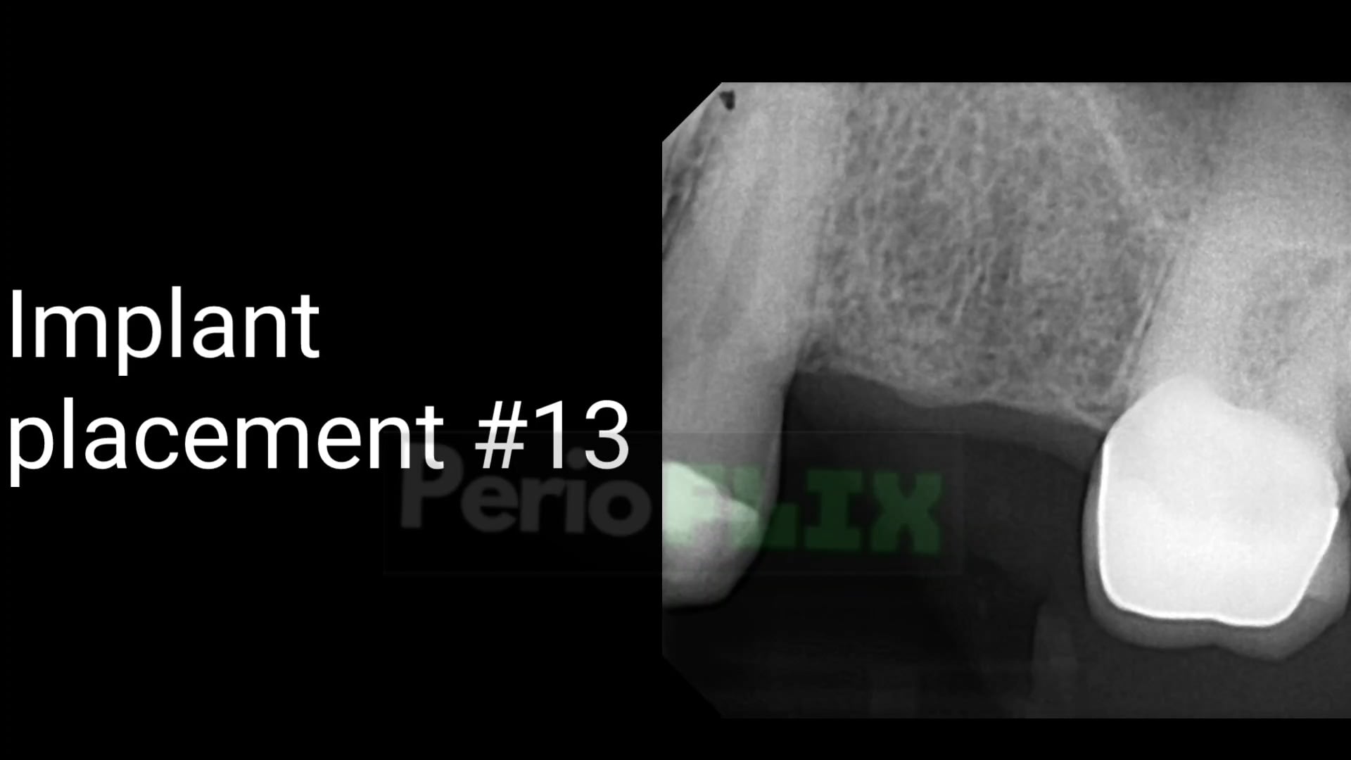 Implant placement #13