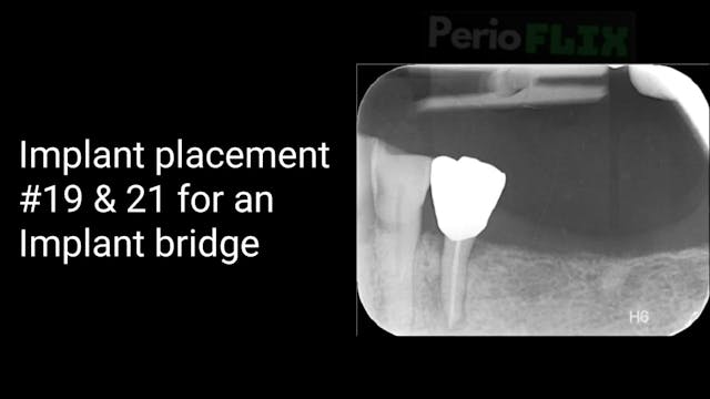 Implant placement 19 21 for Implant b...