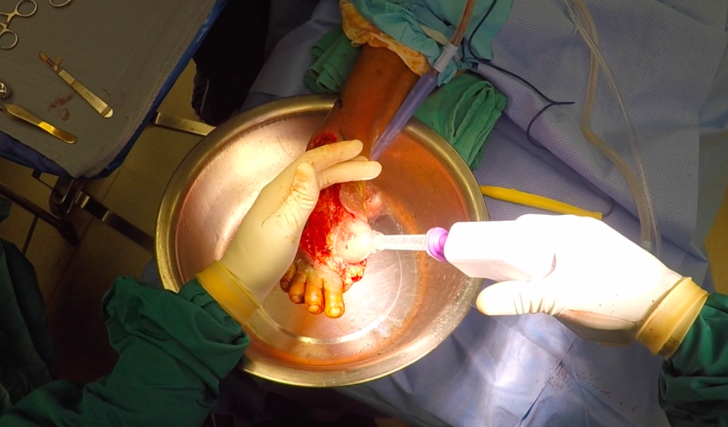 Foot and ankle infections