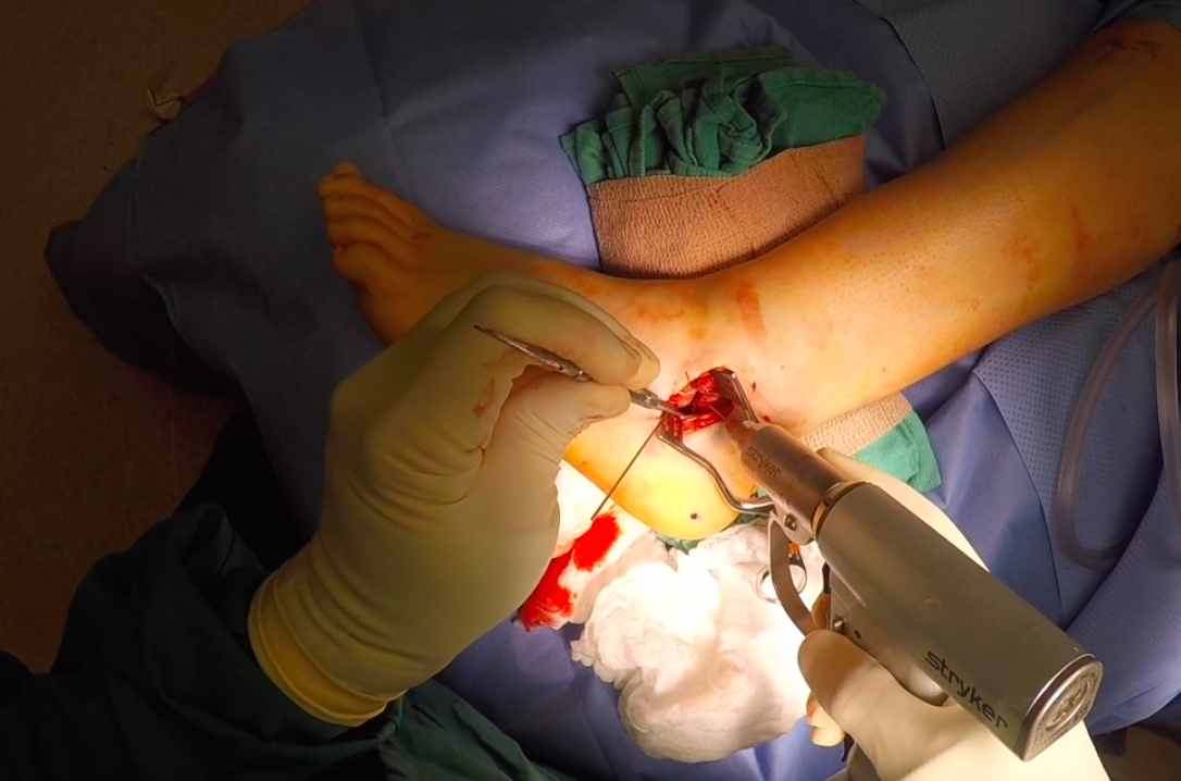 Calcaneus Fracture ORIF