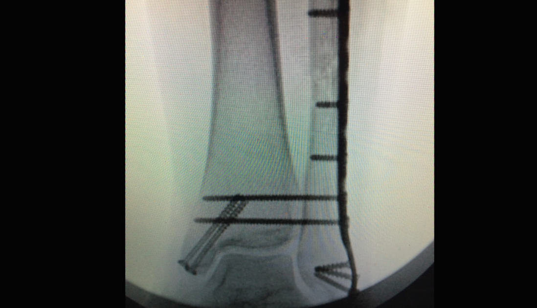 Ankle Fracture 