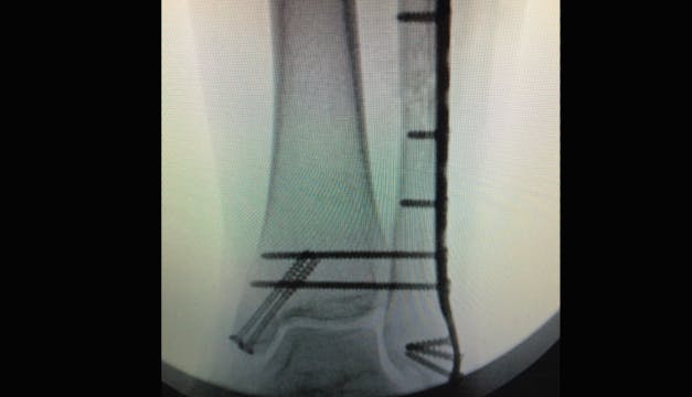 Ankle Fracture 