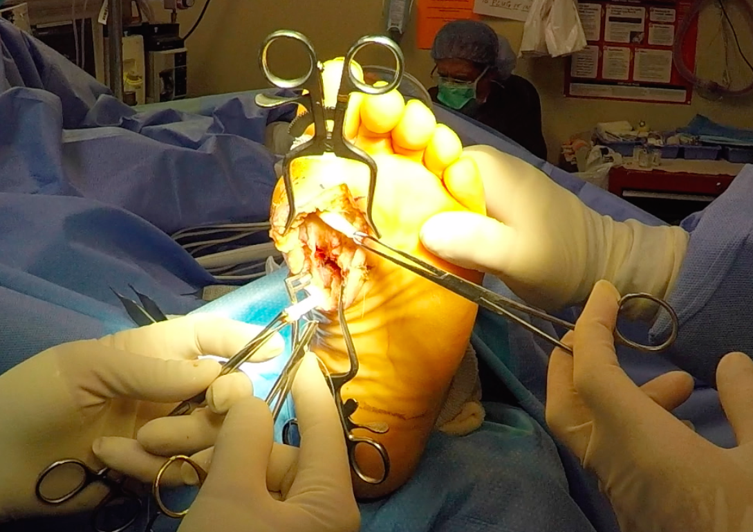 Flexor Tendon Rupture