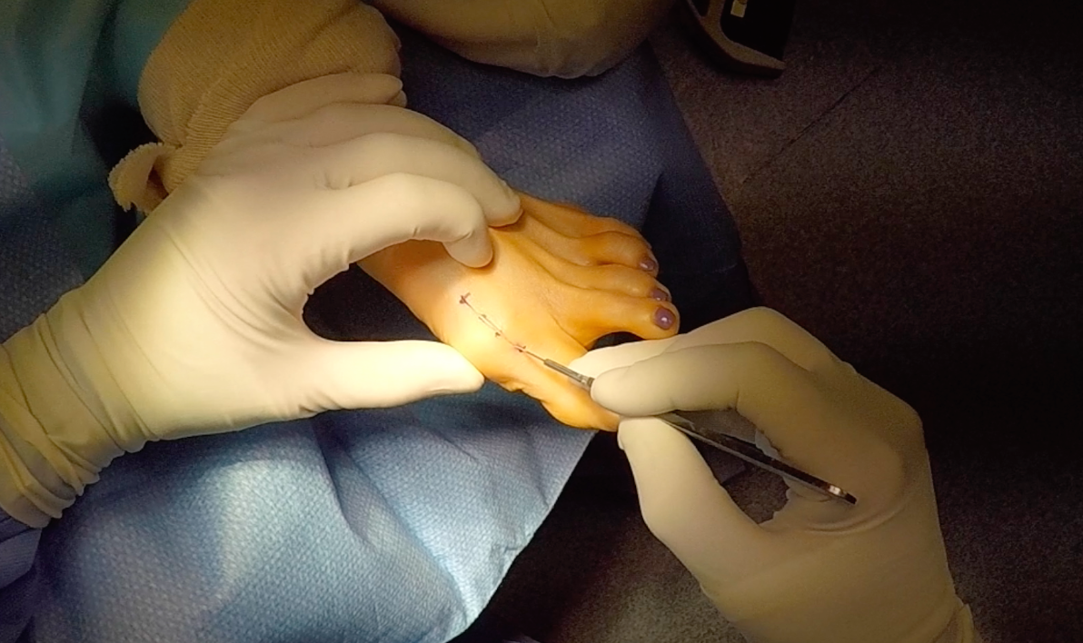 Hallux Valgus Correction