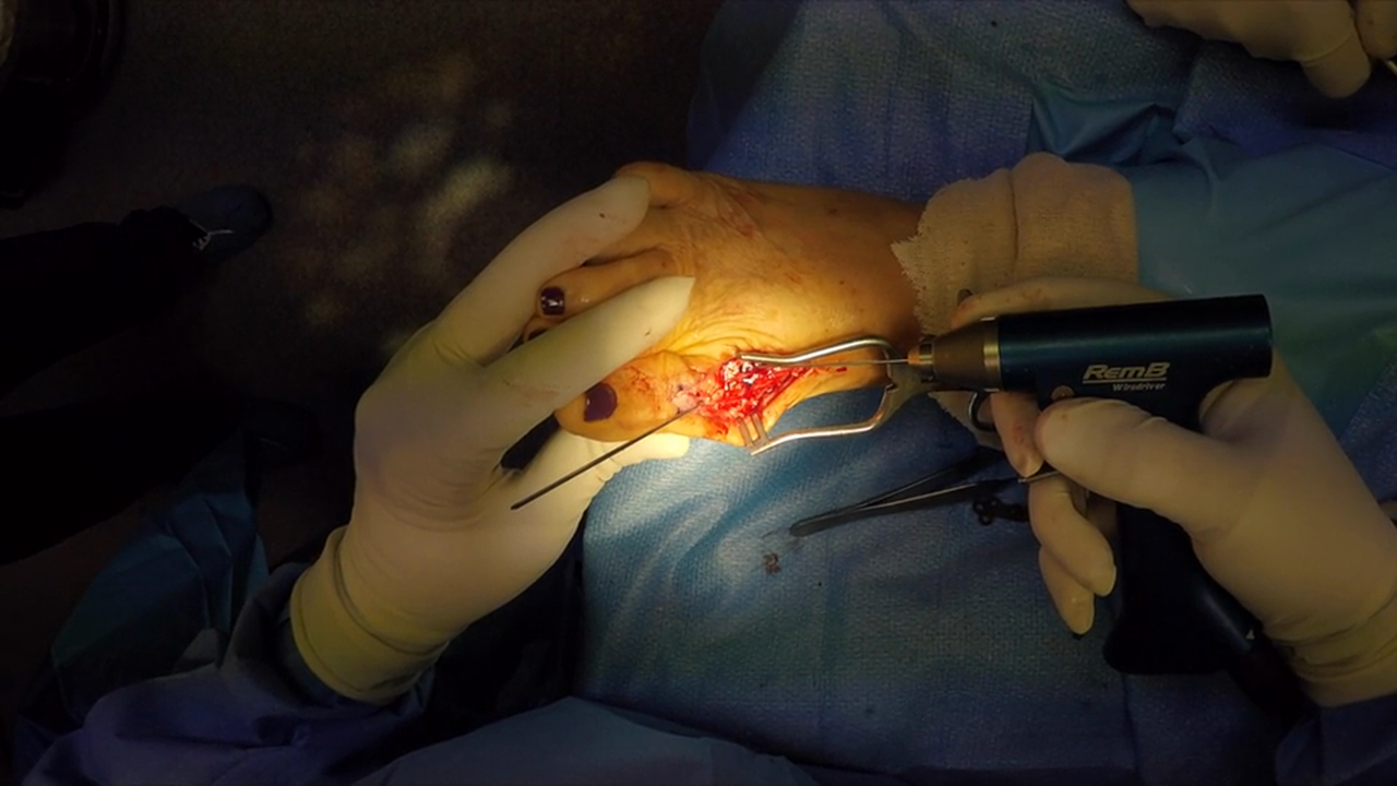 1st MPJ Fusion Revision w VO