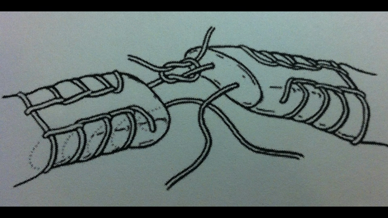 Achilles Repair with Graft Application w VO