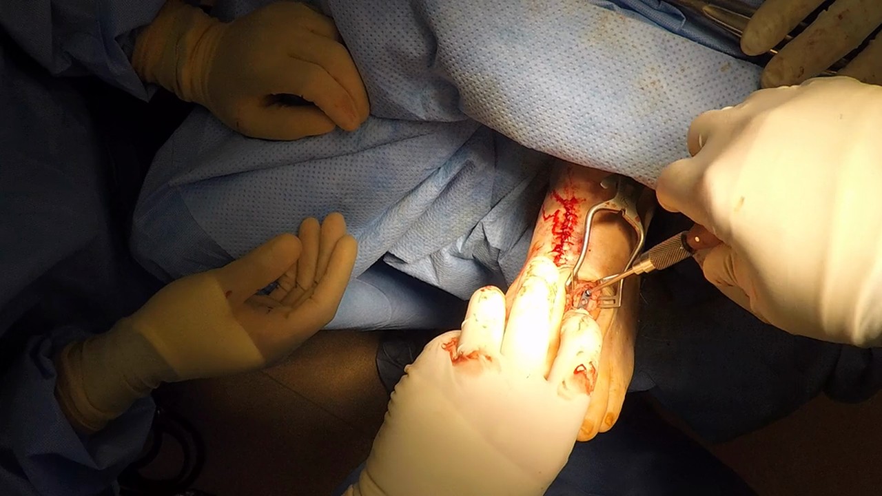 2nd Met Shortening Osteotomy w VO