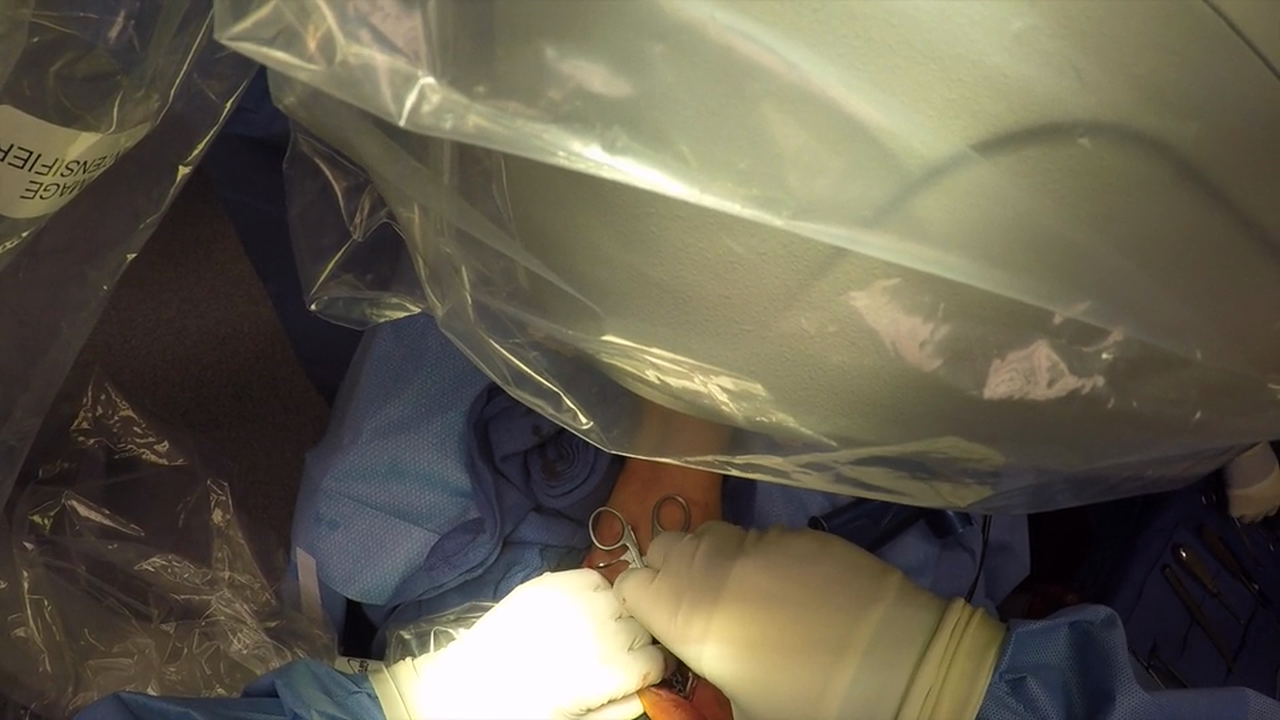 5th Met Fx ORIF w VO