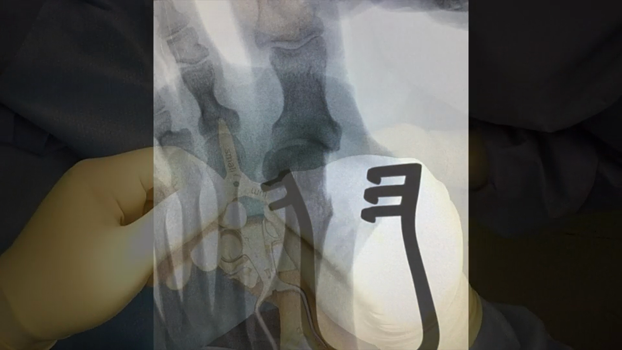 Bunion ITS PLate w VO