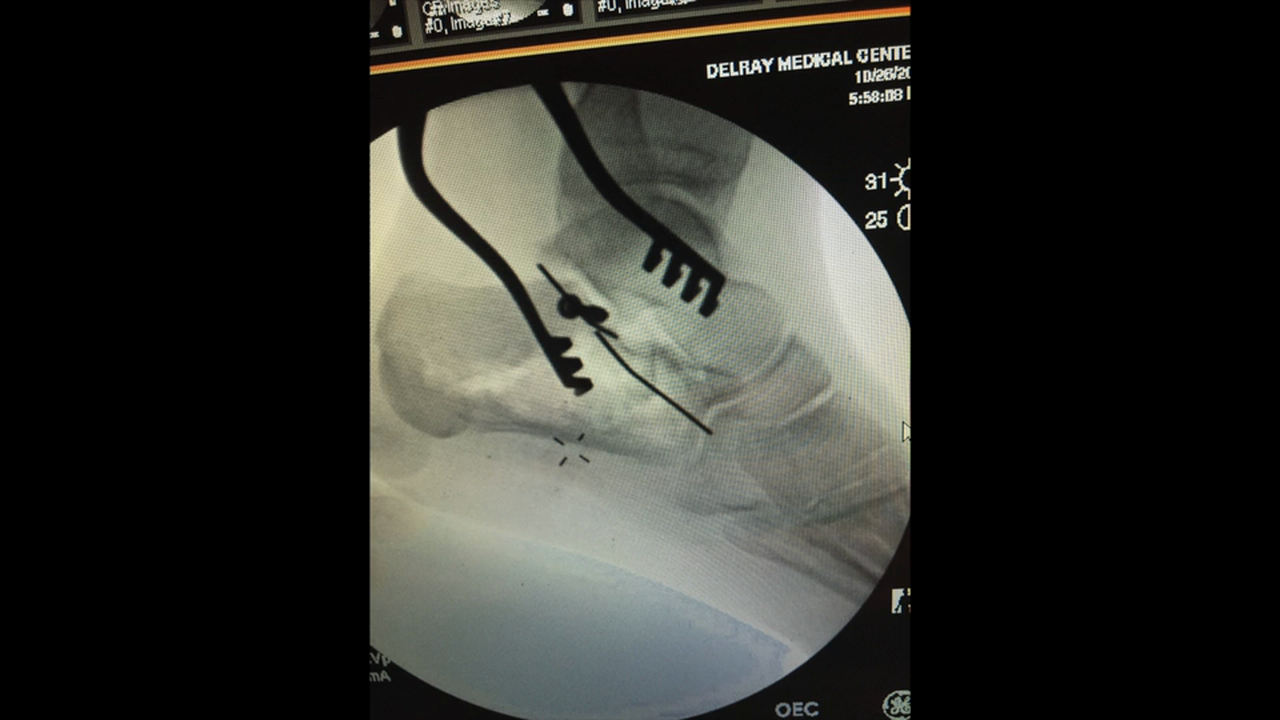 Calc Fx ORIF with ExFix w VO