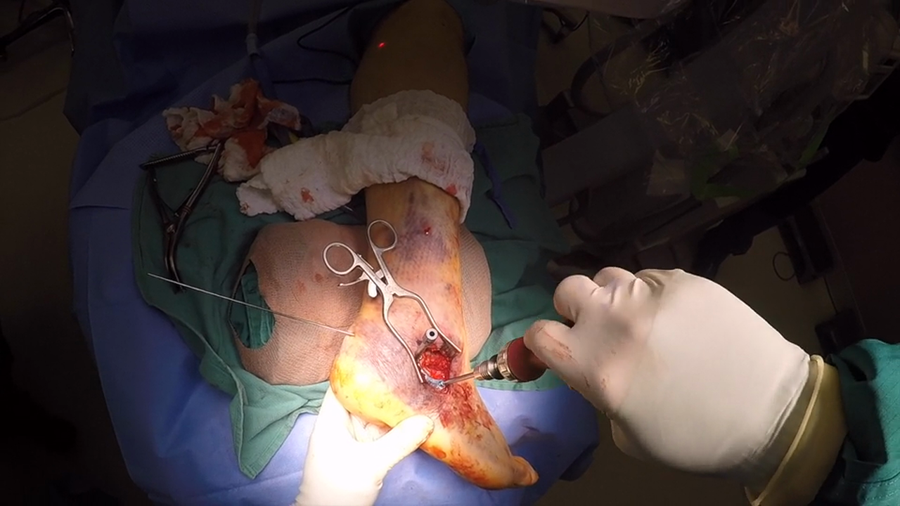 Calc Fx Orthohelix Plate w VO