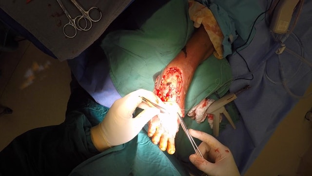 Foot Infection & Graft w VO