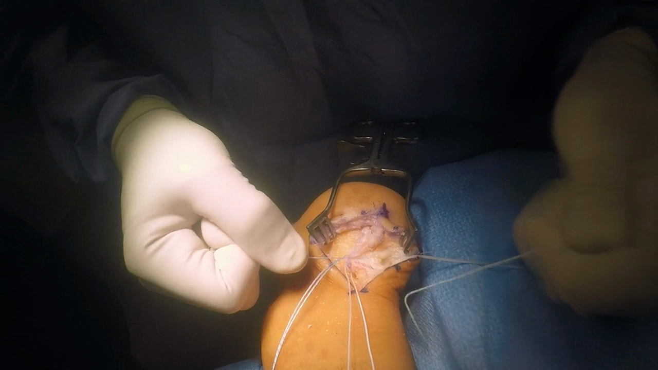 Haglund's Repair w VO