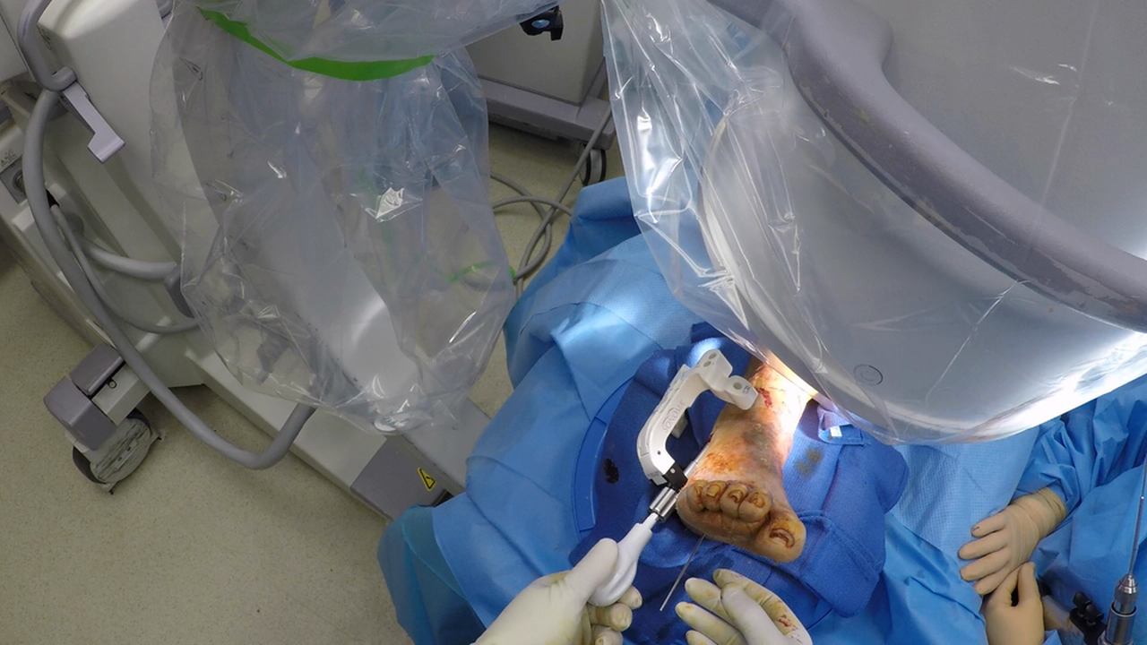 Sonoma Fibula Rod Jan 2016 w VO