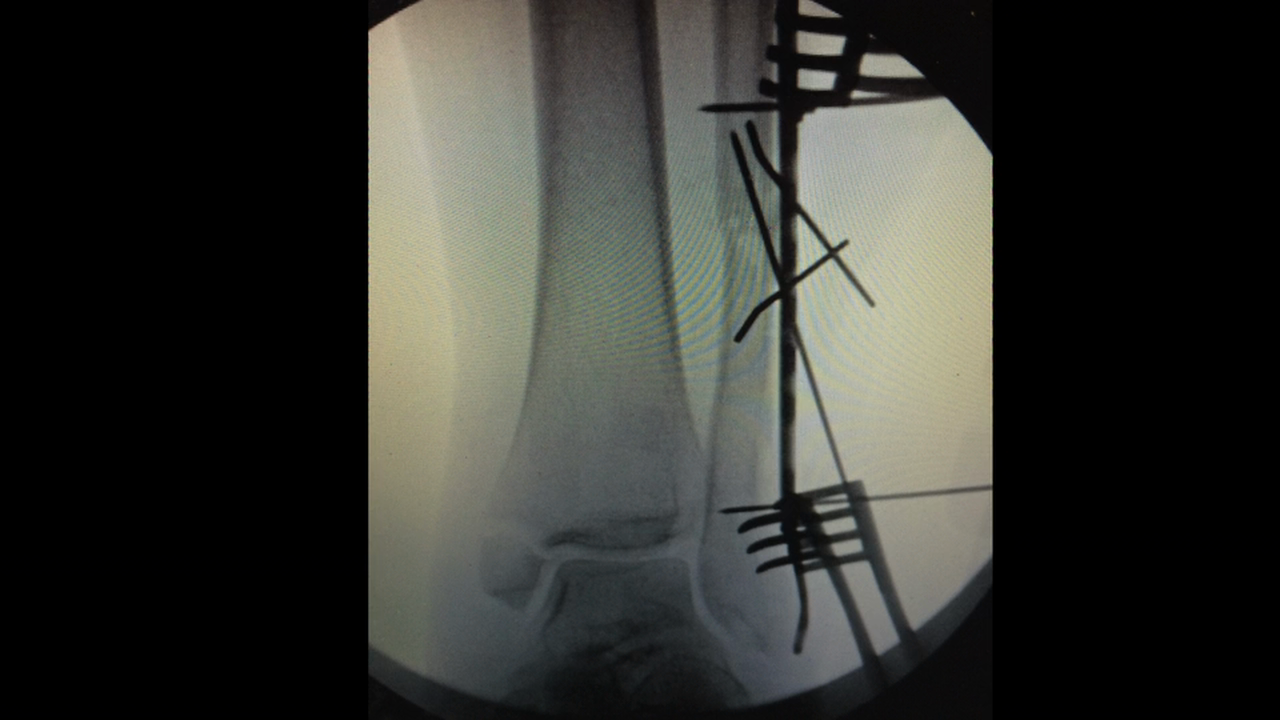 Ankle Fx July 27 w VO