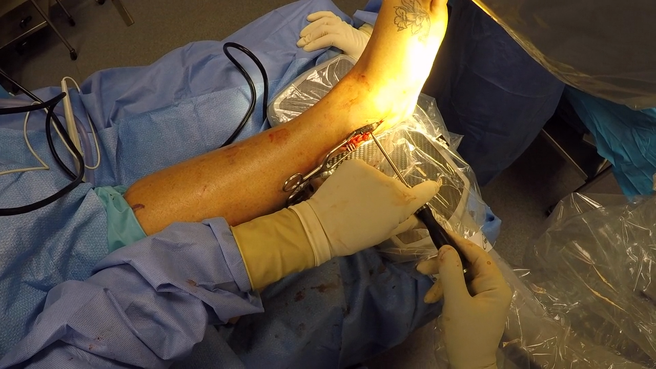 Carbofix Ankle w VO April 2016 SS