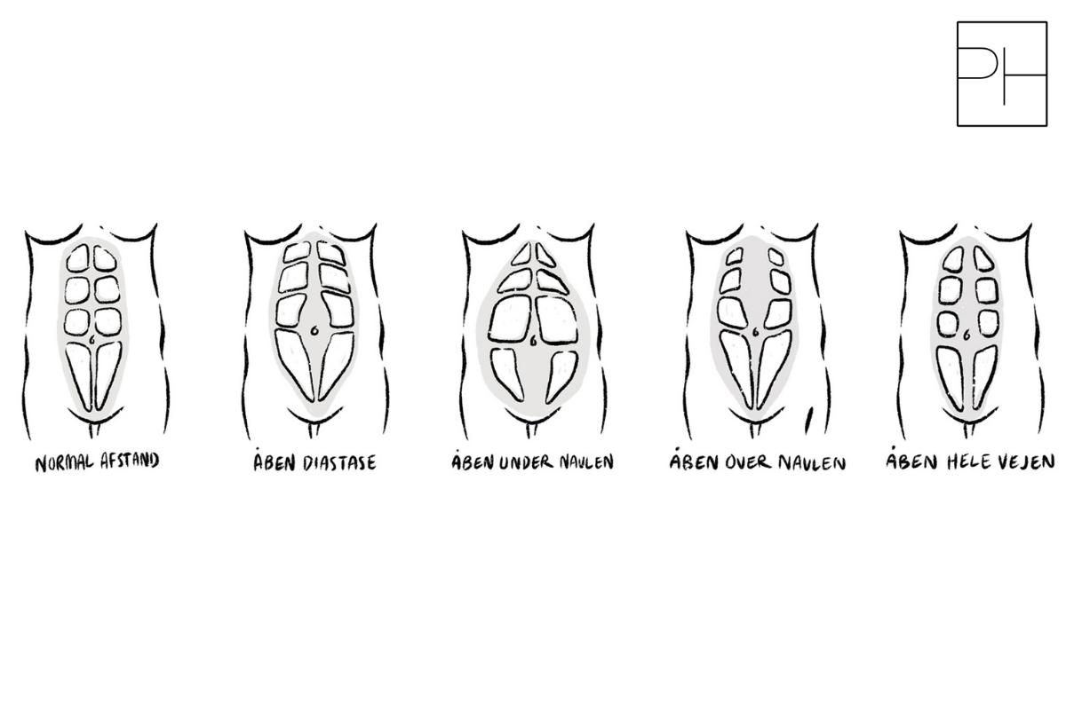 Øvelser til delte mavemuskler