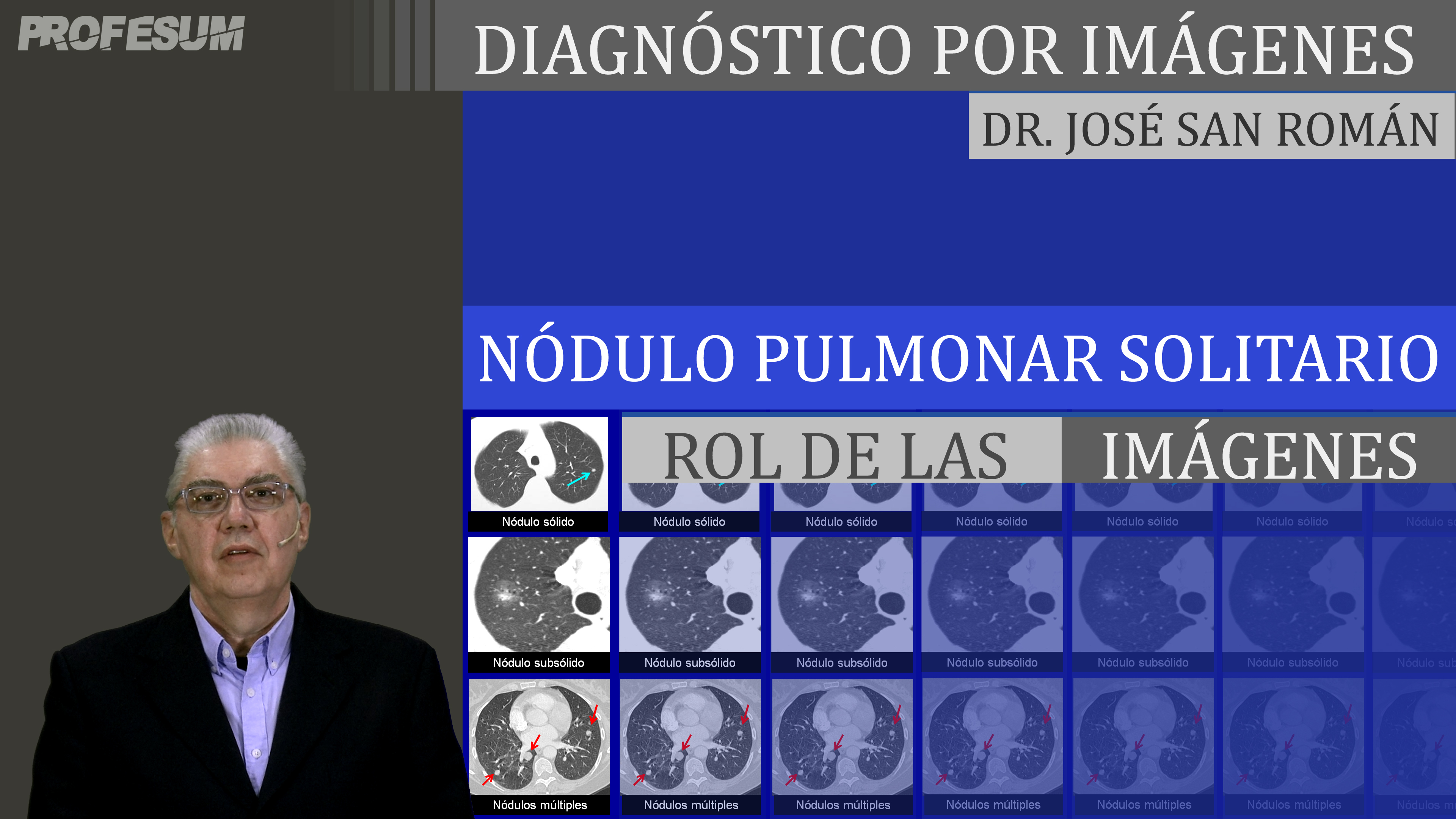 Nódulo Pulmonar Solitario (Rol de las Imágenes) - Dr. José San Román