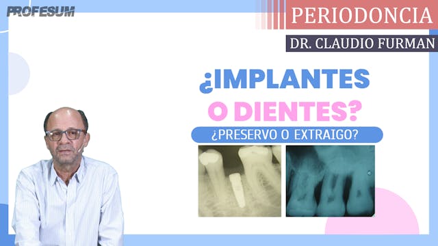 ¿Implantes o Dientes? ¿Preservo o Ext...