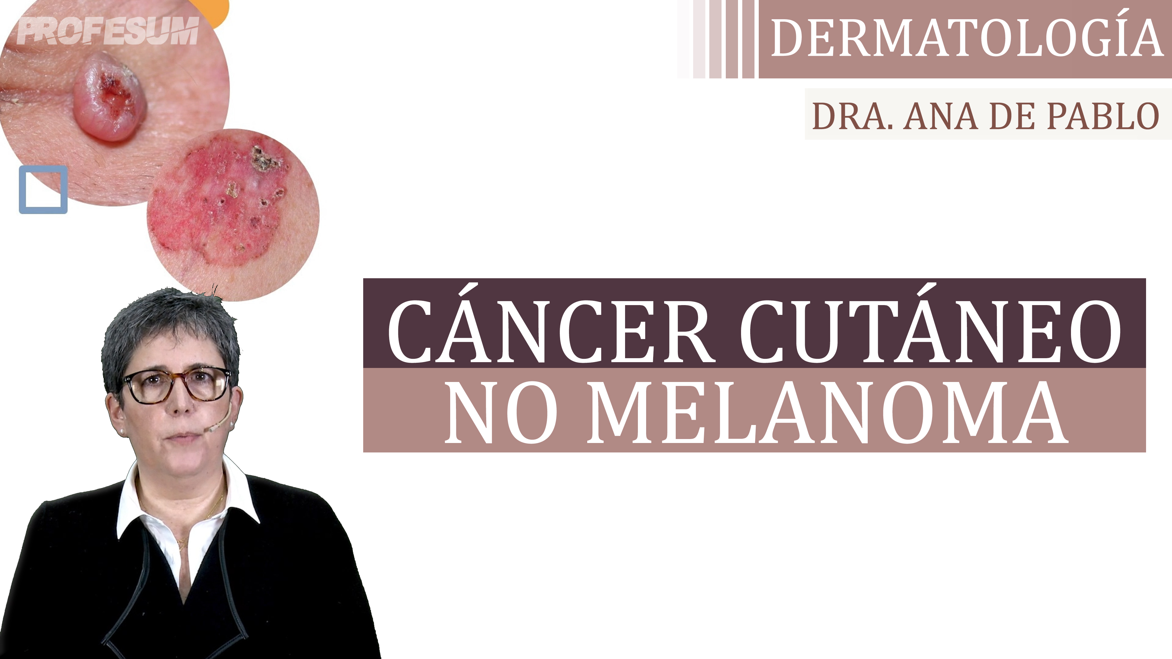 Cáncer Cutáneo No Melanoma - Dra. De Pablo