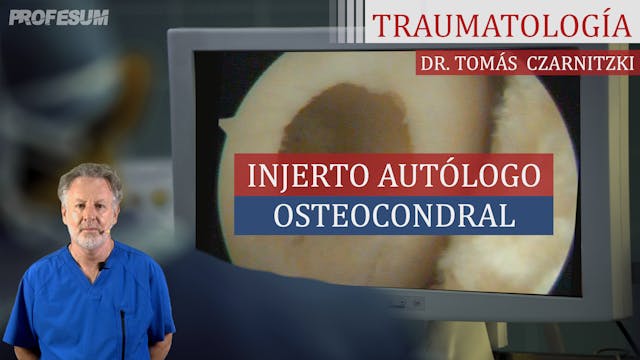 Injerto Autólogo Osteocondral - Osteo...