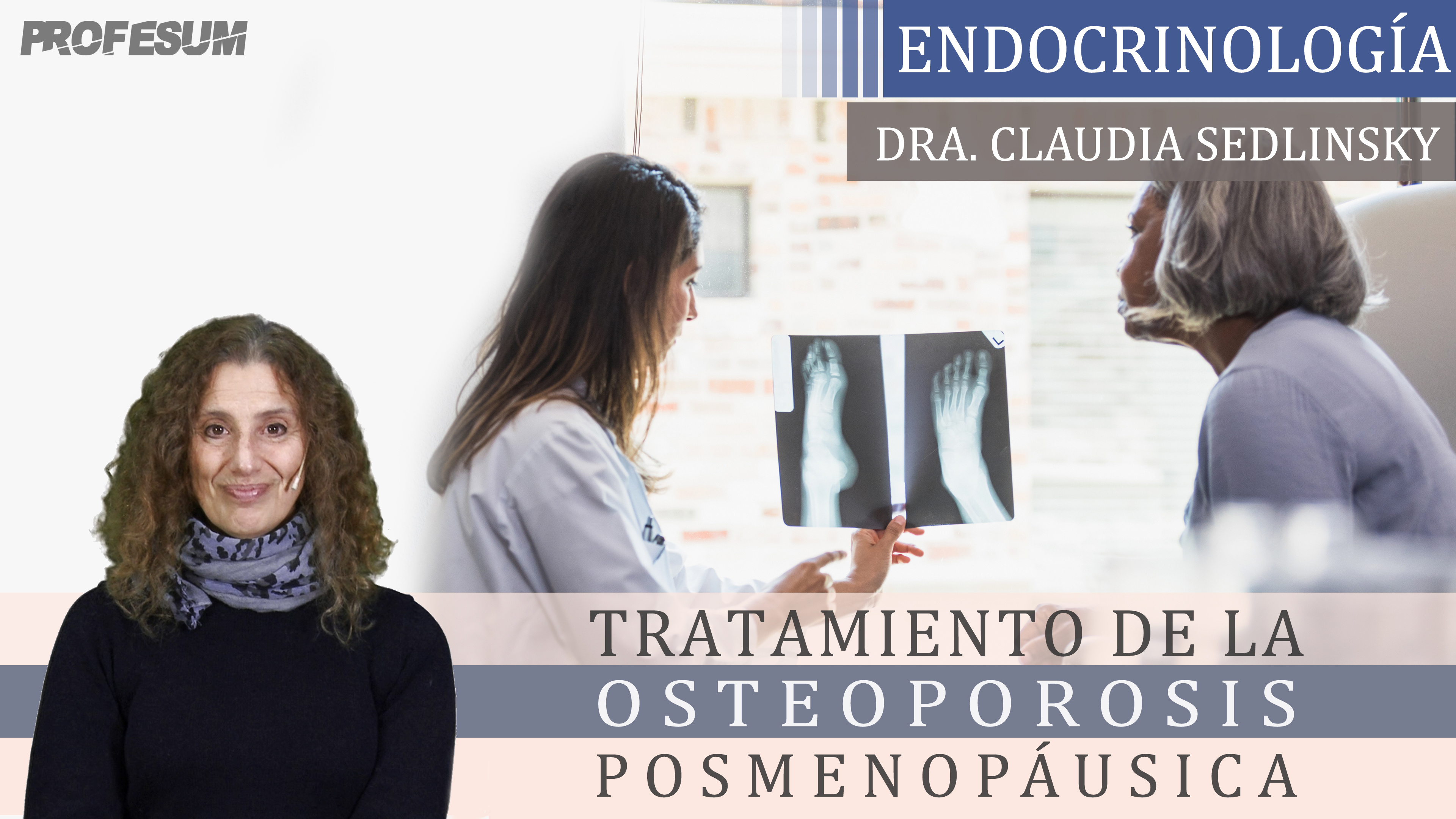 Tratamiento de la Osteoporosis Posmenopáusica - Conceptos Actuales