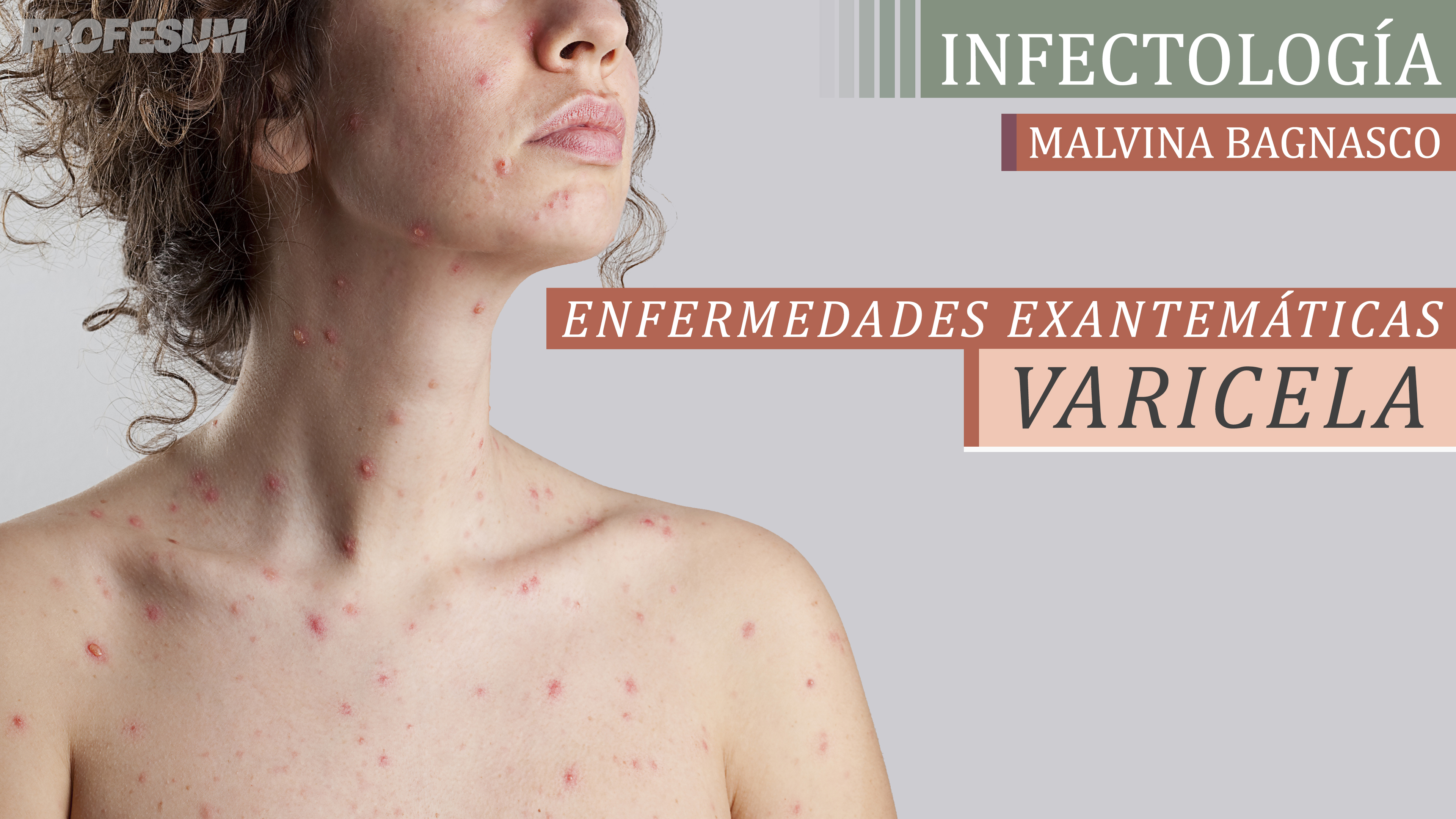 Varicela - Malvina Bagnasco