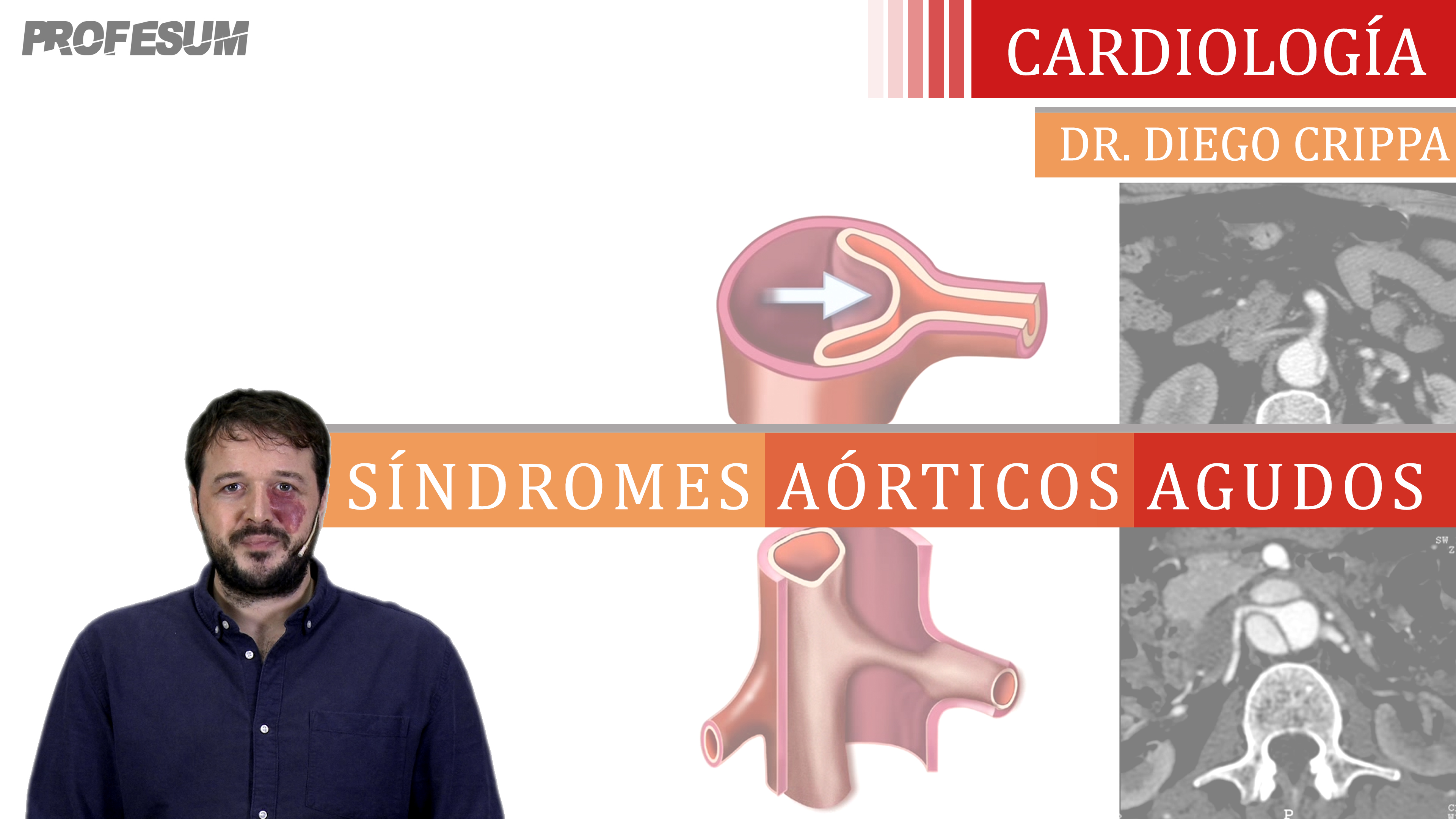 Síndromes Aórticos Agudos - Dr Diego Crippa