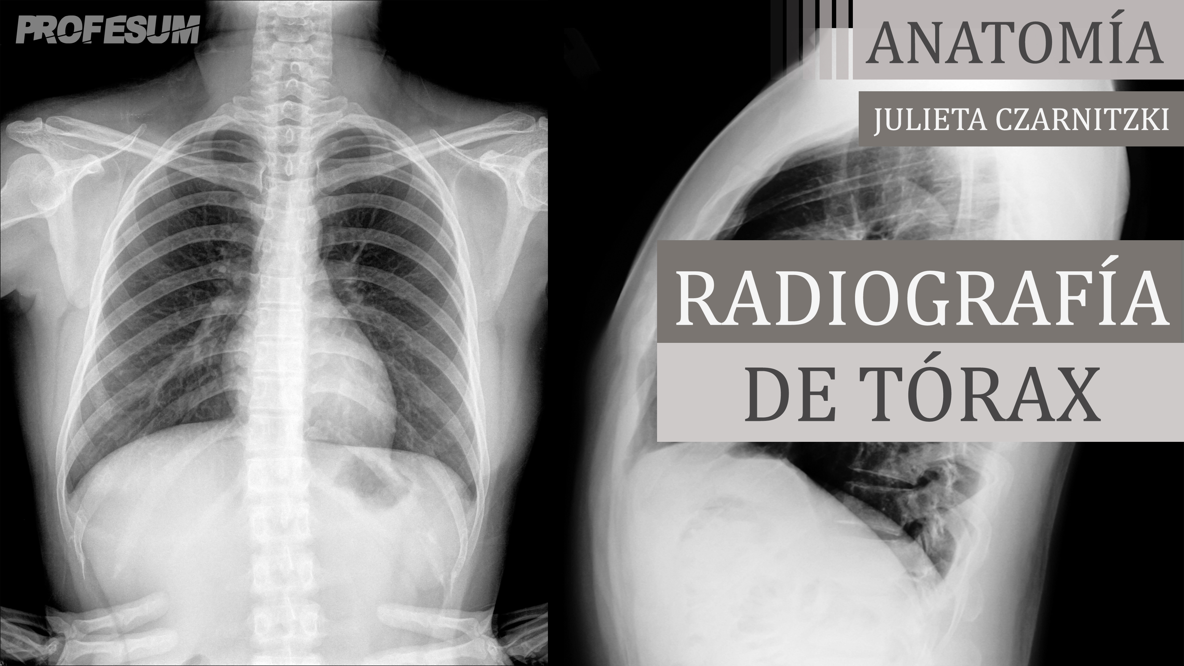 Radiografía de Tórax - Julieta Czarnitzki