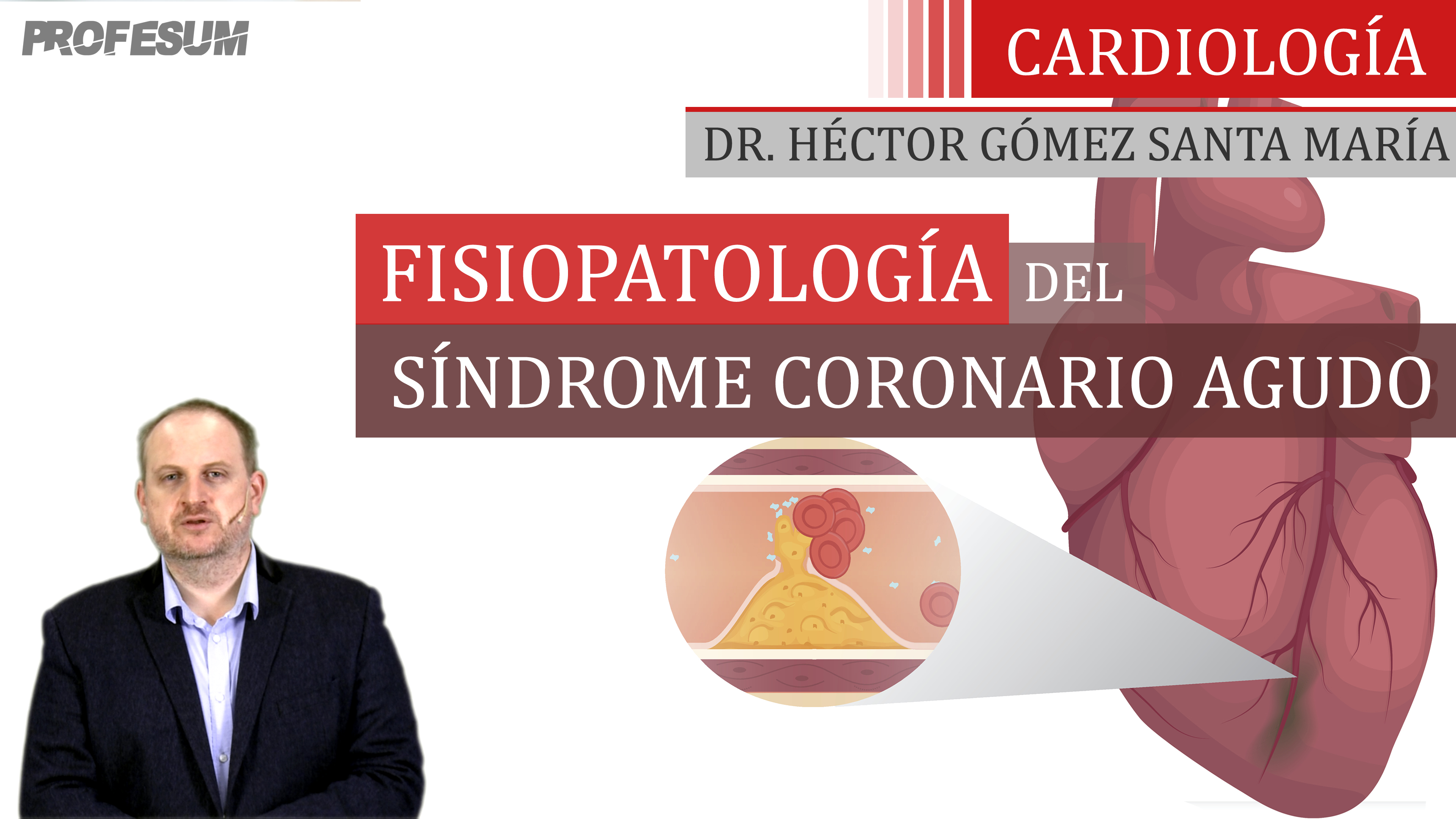 Fisiopatología del SCA - Dr. Héctor Gómez Santa María