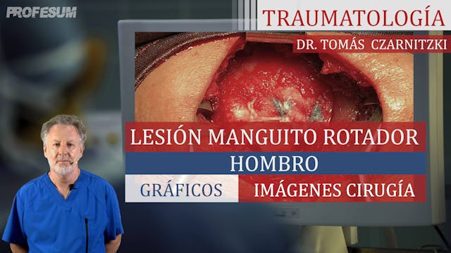 Lesión Manguito Rotador - Hombro - Dr...
