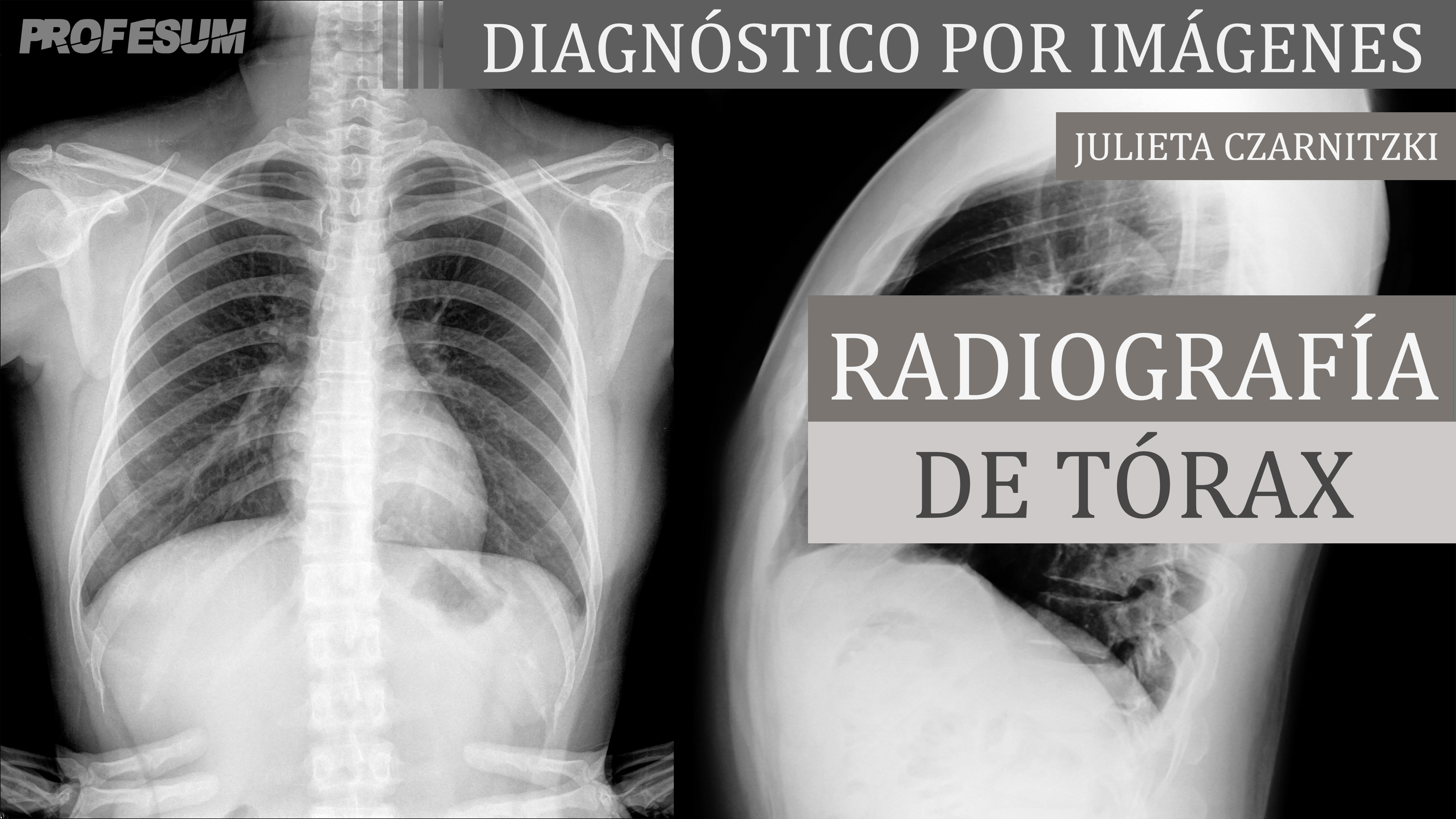 Radiografía de Tórax - Julieta Czarnitzki