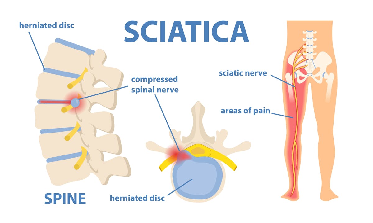 Sciatica Self-care Program