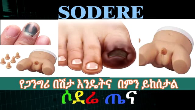 Gangrene causes and symptoms