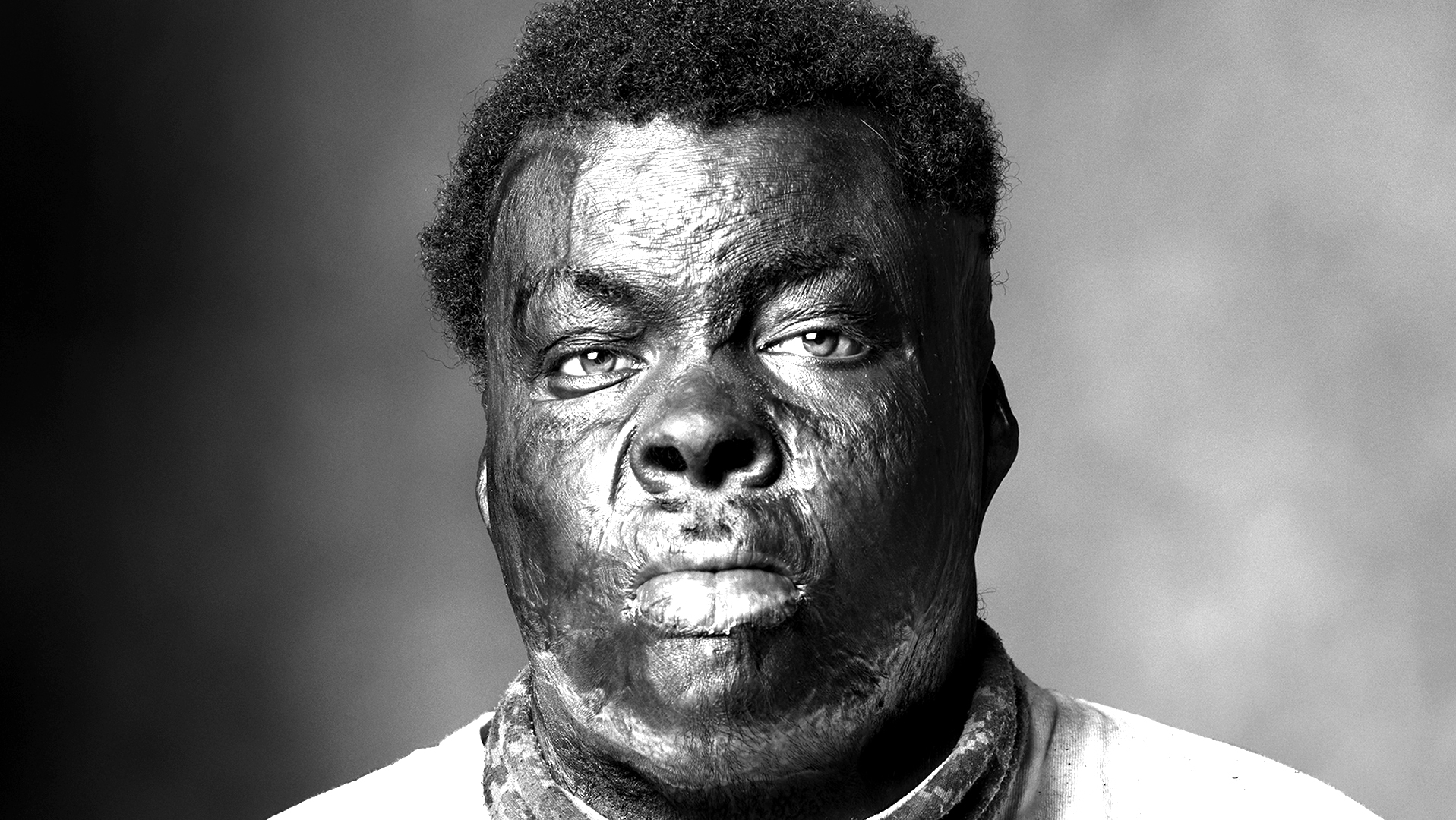 Burn Victim interview-Joshua